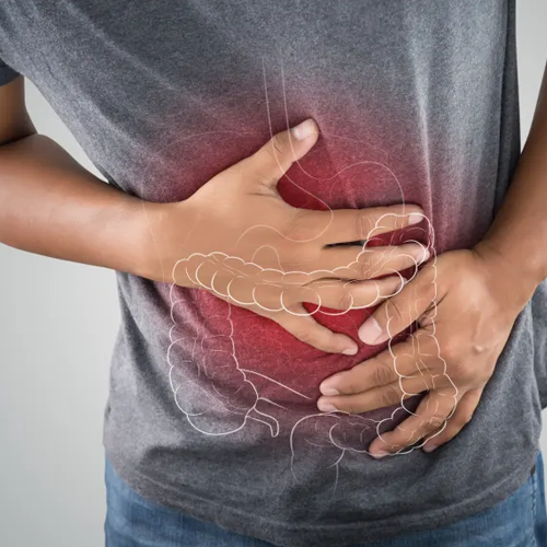 Colon cancer 